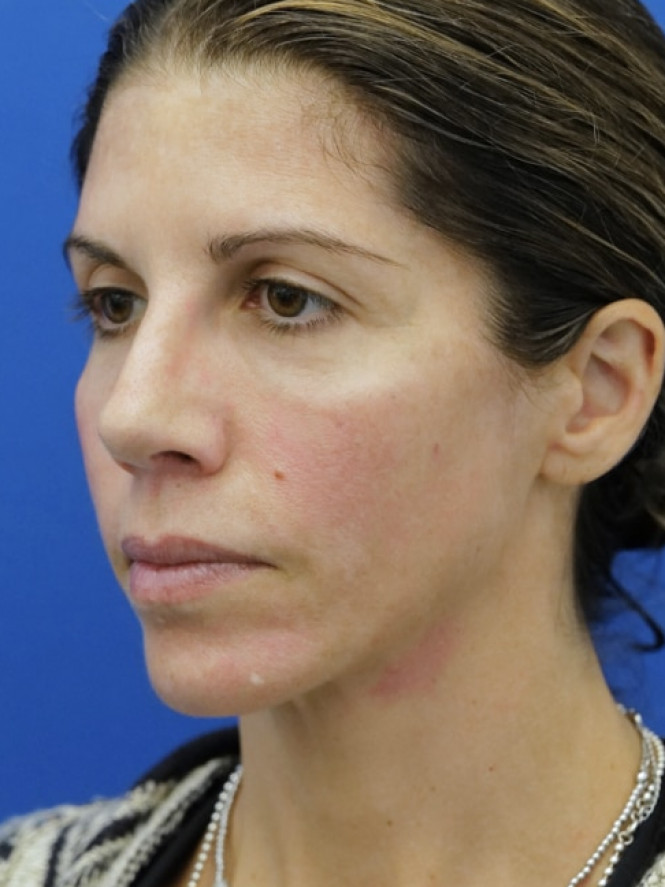 Brow Tip Aesthetic Line — After