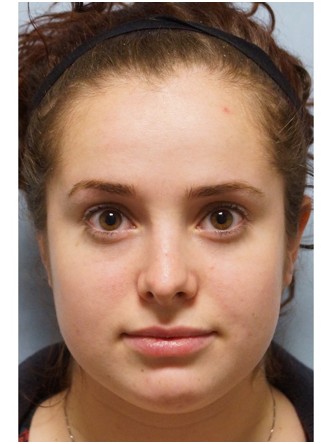 Crooked Nose Endonasal Technique1* — After