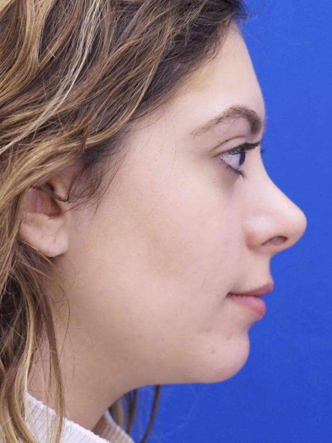 Hump Reduction and Chin Projection — After