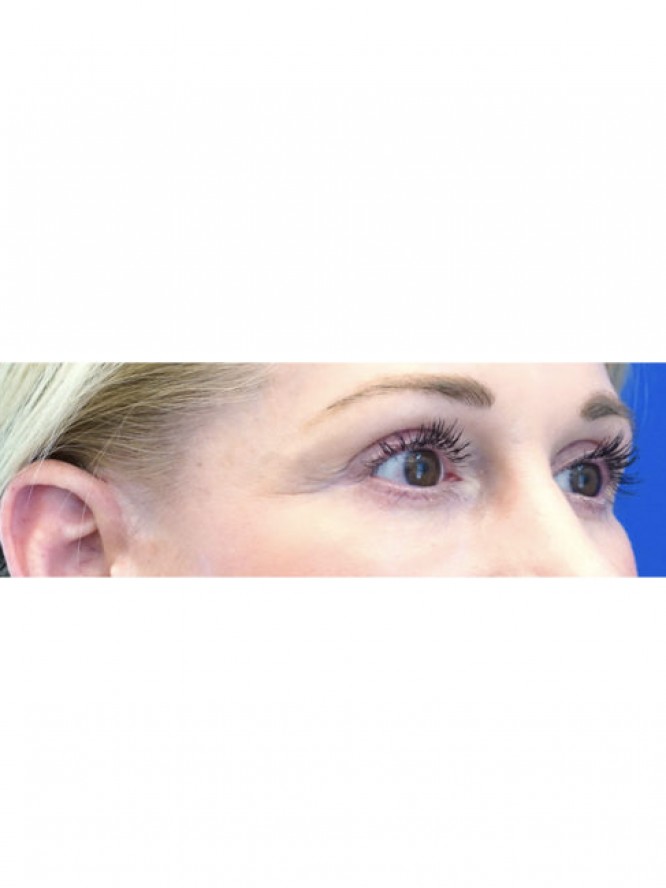 Lower Blepharoplasty and Fat Grafting — After