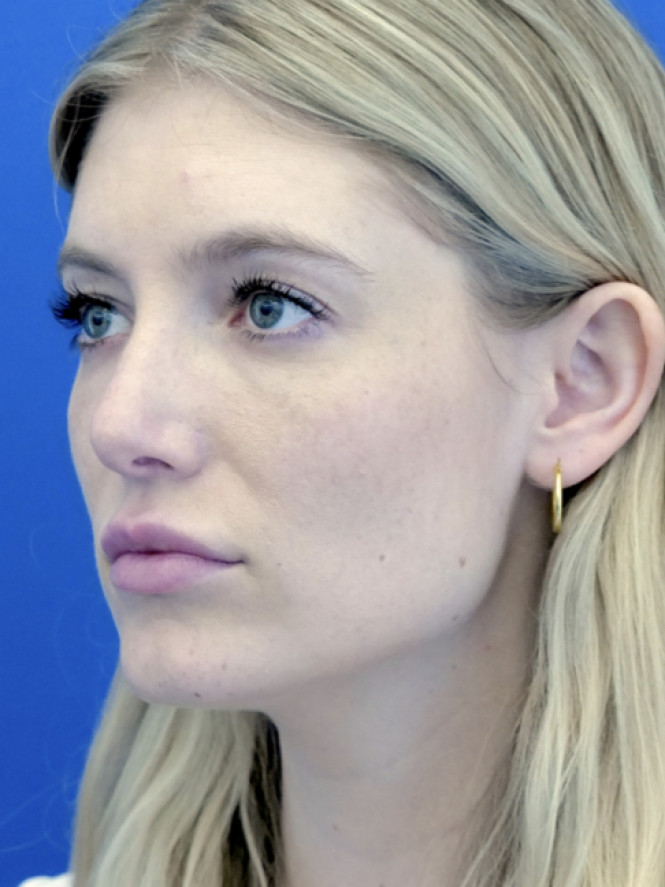 Aesthetic Nasal Contour — After