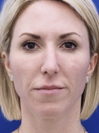 Aesthetic Nasal Contour* — Before