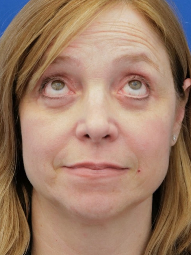 Upper and Lower Blepharoplasty — After