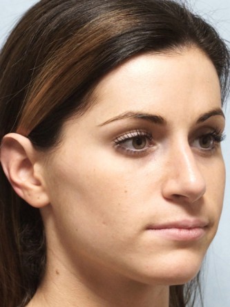 Mild Dorsal Hump & Droopy Tip1* — After