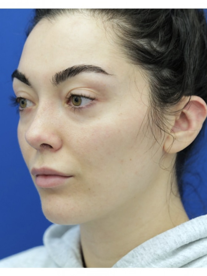Ideal Nasal Profile — After