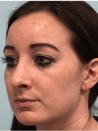 Droopy Tip – Revision* — Before