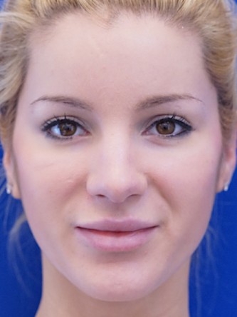 Restylane Silk Highlights Beautiful Lips* — After