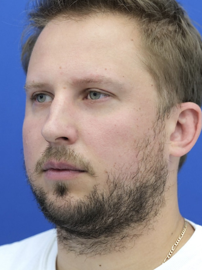 Dorsal Hump and Chin Augmentation — Before
