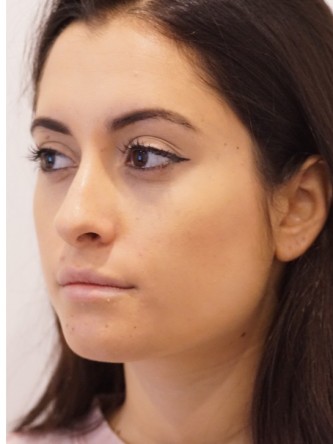 Restylane Silk to Volumize Lower Lip* — After