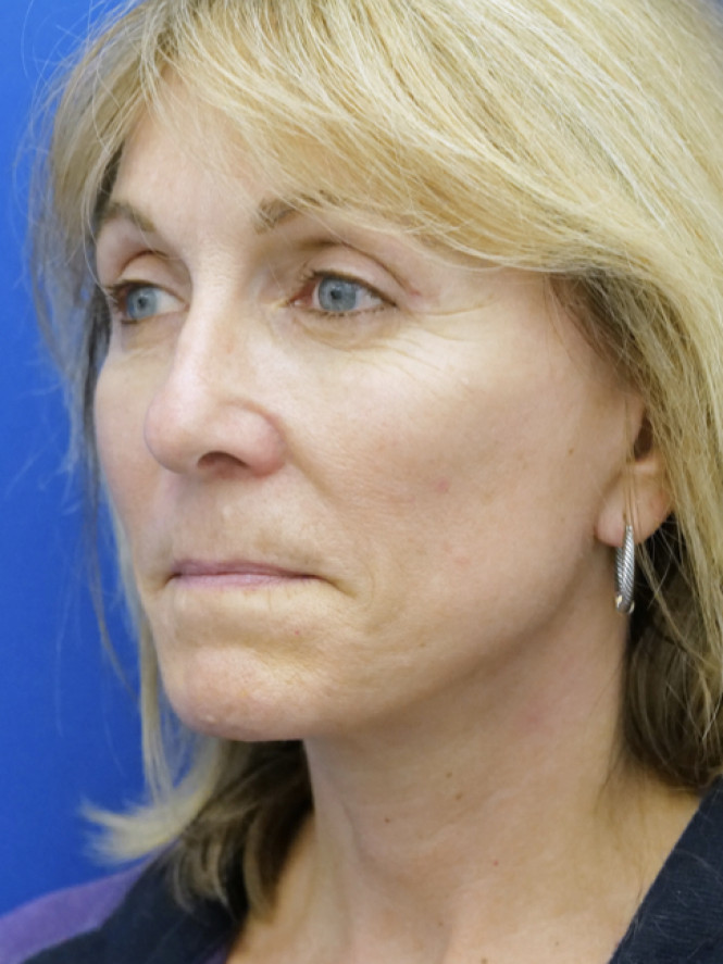 Hairline Browlift — After