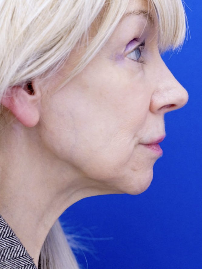 Crisp Jaw and Neck Lines — Before
