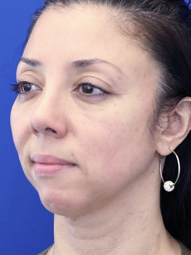 Natural Result — After