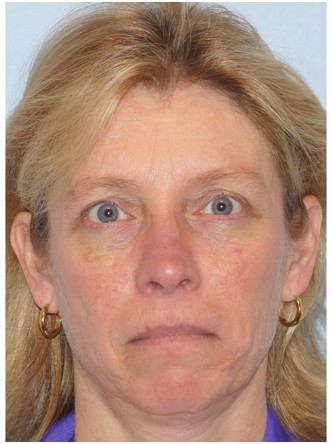 Upper Eyelid Droop1 (Ptosis)* — After