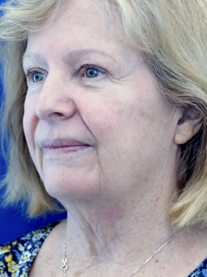 Deep Plane Jowl and Neck Lift — Before