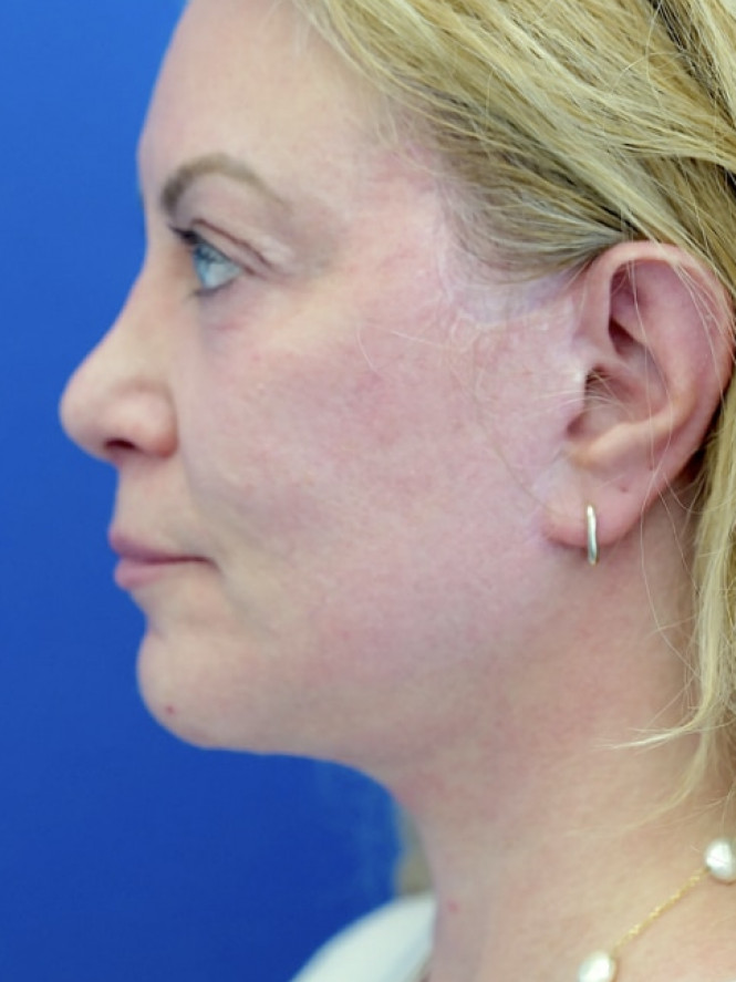 Lower Facial and Neck Fullness — After