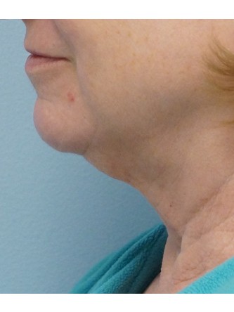 Redundant Neck Skin* — Before