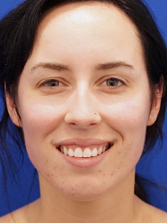 Chin Implant and Upper Lip Filler* — Before