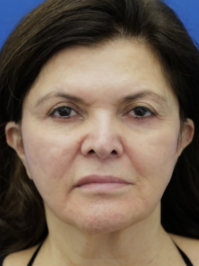 Lower Facelift Chin Reduction — Before