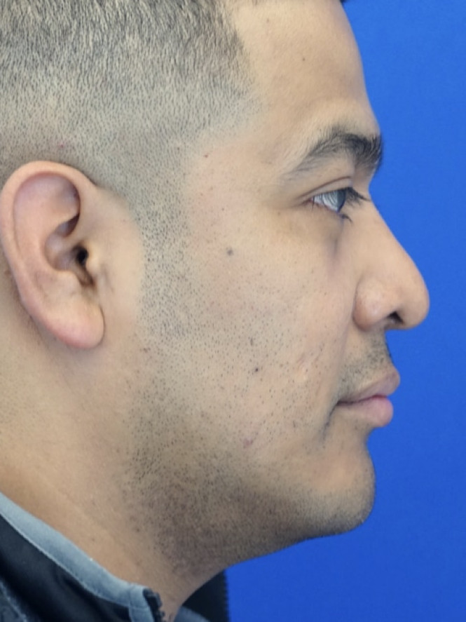 Rhinoplasty Trifecta — Before