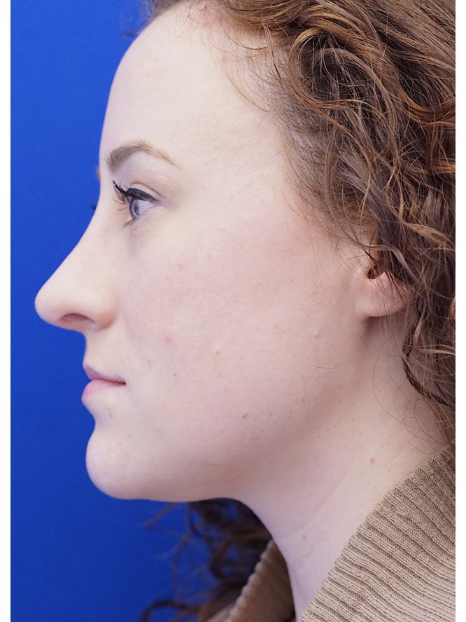 Finesse Nasal Contour — After