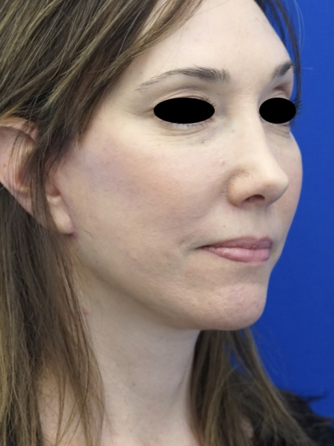 Secondary Deep Plane Lift with Scar Revision — After
