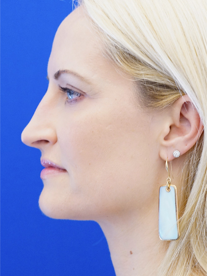 Nasal Profile Finesse — Before