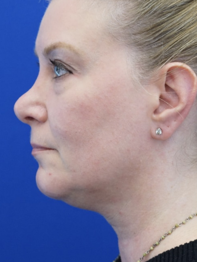 Lower Facial and Neck Fullness — Before