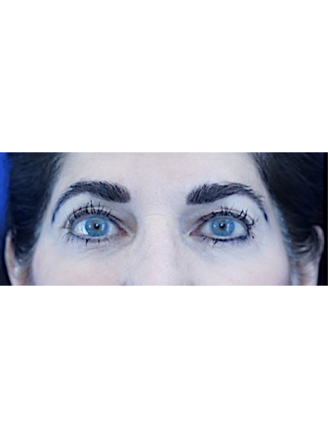 Eyelid Crease Refreshening — Before
