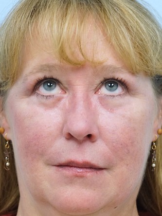 Upper and Lower Eyelid Blepharoplasty* — After