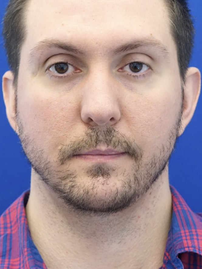 Lower Facial Contouring — After