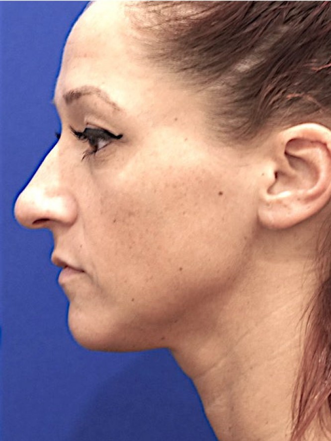 Dainty Nose — Before