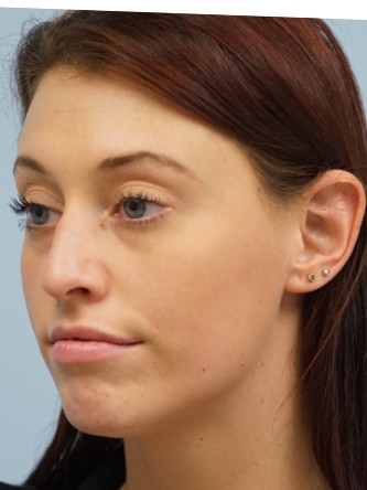 Cupid’s Bow Enhancement by Juvederm* — Before