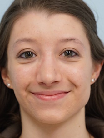 Prominent Nose Closed Rhinoplasty* — After