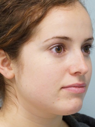 Crooked Nose Endonasal Technique1* — Before