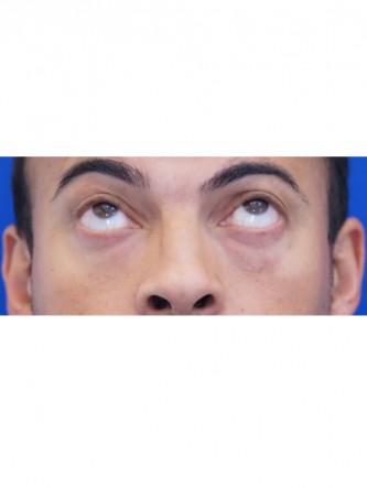 Fat Transfer to Lower Eyelid* — Before