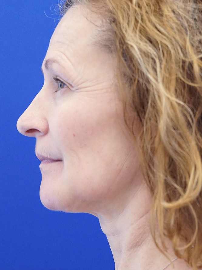 Prominent Chin — After