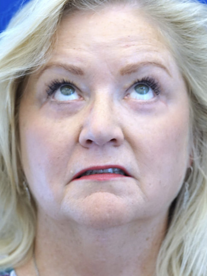 Lower Eyelid Rejuvenation — After