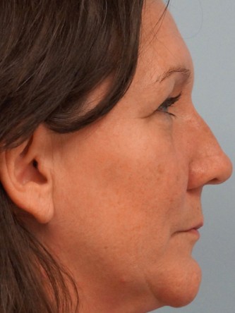 Juvederm to Upper Lip* — Before