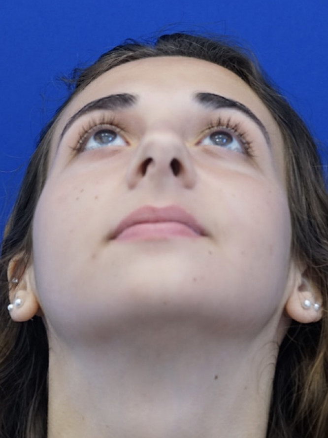 Classic Tension Nose — Before