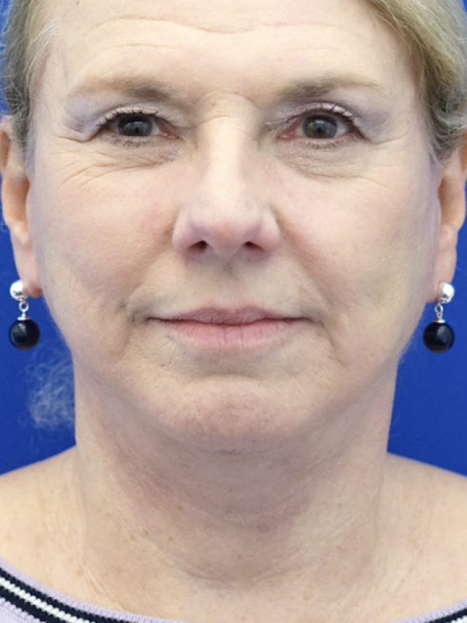 Lower Facial Aging and Fullness — After