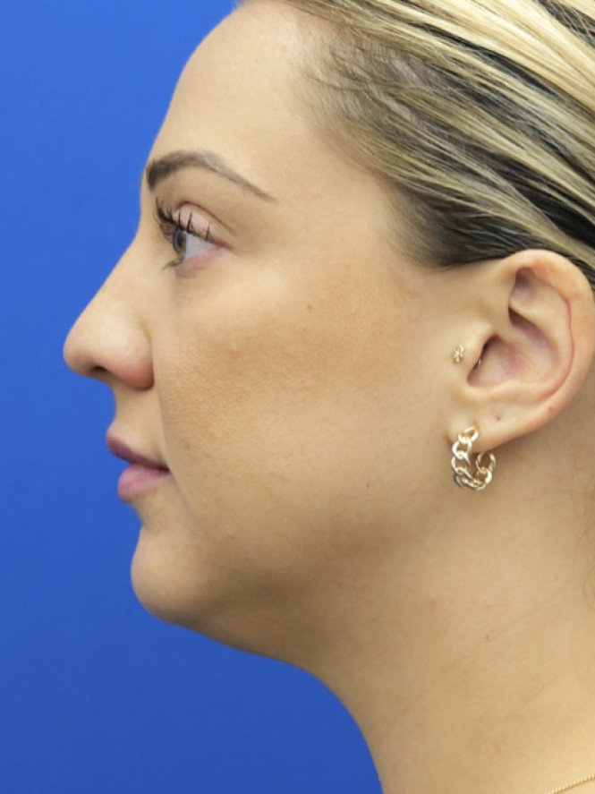 Lower Facial Rejuvenation — Before