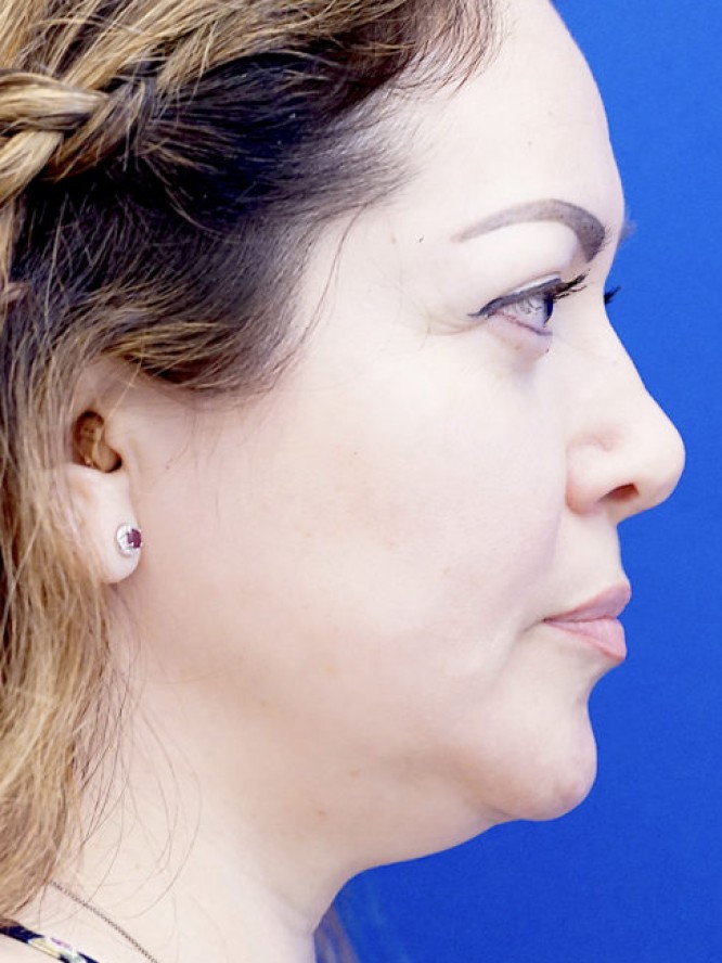 Nasal Tip Asymmetry — Before
