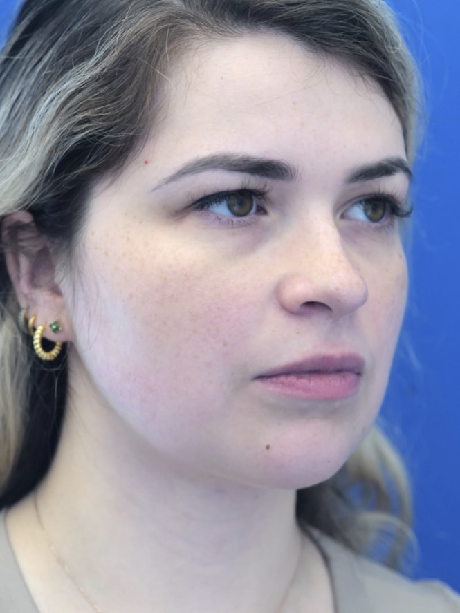 Underchin Fullness — After
