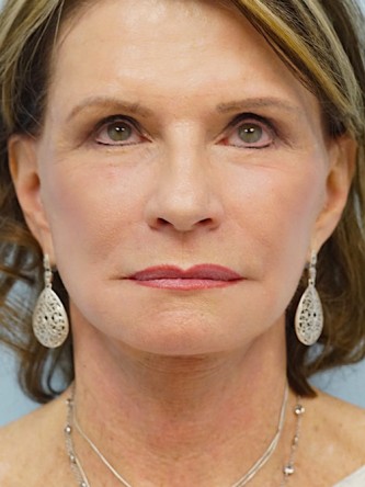 Face/Necklift, Aging Eyelid Surgery, Facial Fat Graft, Laser Resurfacing* — After