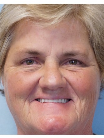 Brow Droop & Upper Eyelid Skin Excess* — After