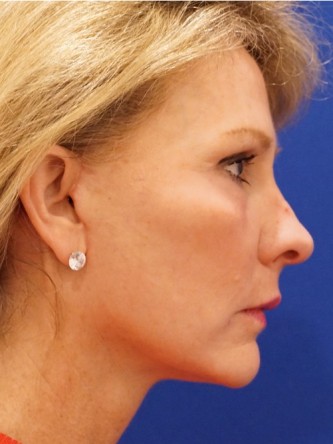 Mini Facelift* — After