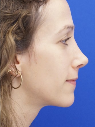Long Nose Hanging Columella — After
