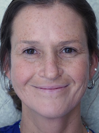 Excess Upper Eyelid Skin* — After