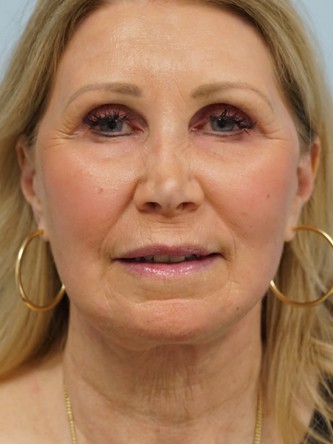 Endoscopic Browlift, Facial Fat Graft, Full Facelift, Fractional CO2 Laser* — After