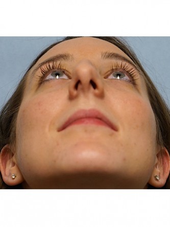Nasal Hump Endonasal Rhinoplasty* — Before